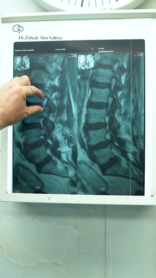 Facet Joint Decompression: When the Small Joints of the Spine Cause Big Pain